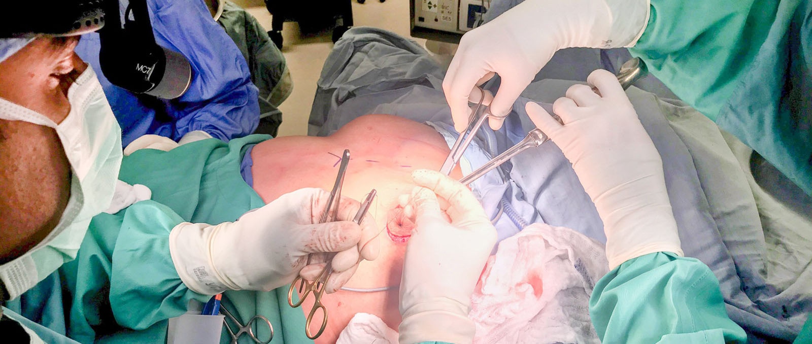 Ist die Brustvergrößerung mit Eigenfett eine sichere Alternative zu Implantaten?